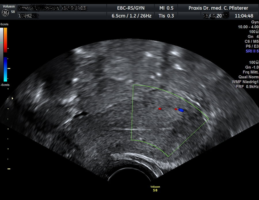 Screenshot eines Ultraschalls